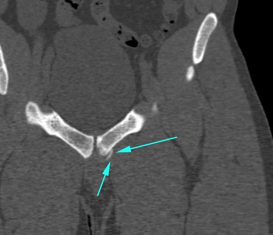 Groin Injuries in Sports 2
