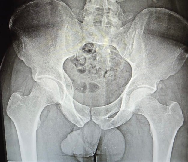 Groin Injuries in Sports 3