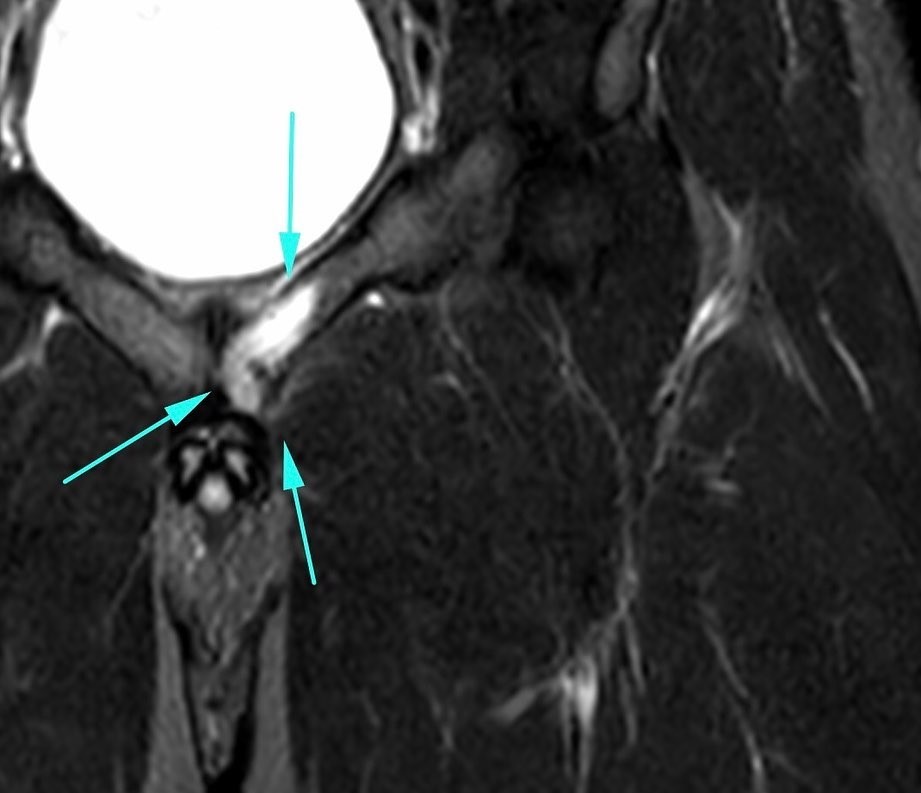 Groin Injuries in Sports 4